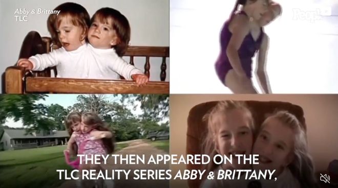 揭秘美連體雙胞胎姐妹之一疑似生子之謎，科學(xué)奇跡還是醫(yī)學(xué)挑戰(zhàn)？