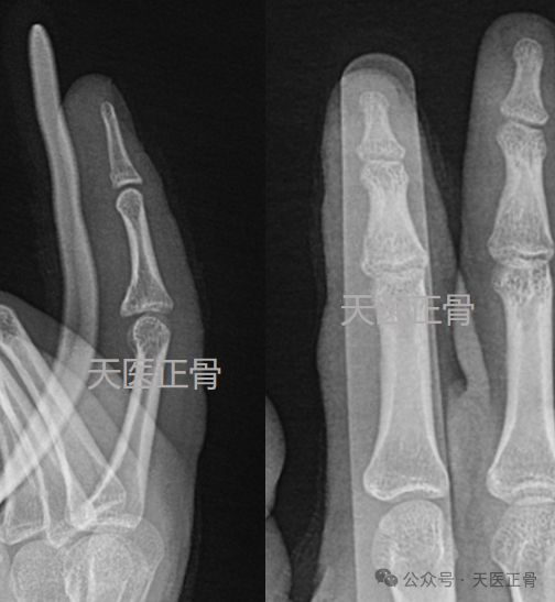 哈滕遭遇左手非移位性骨折，預(yù)計傷停時間出爐